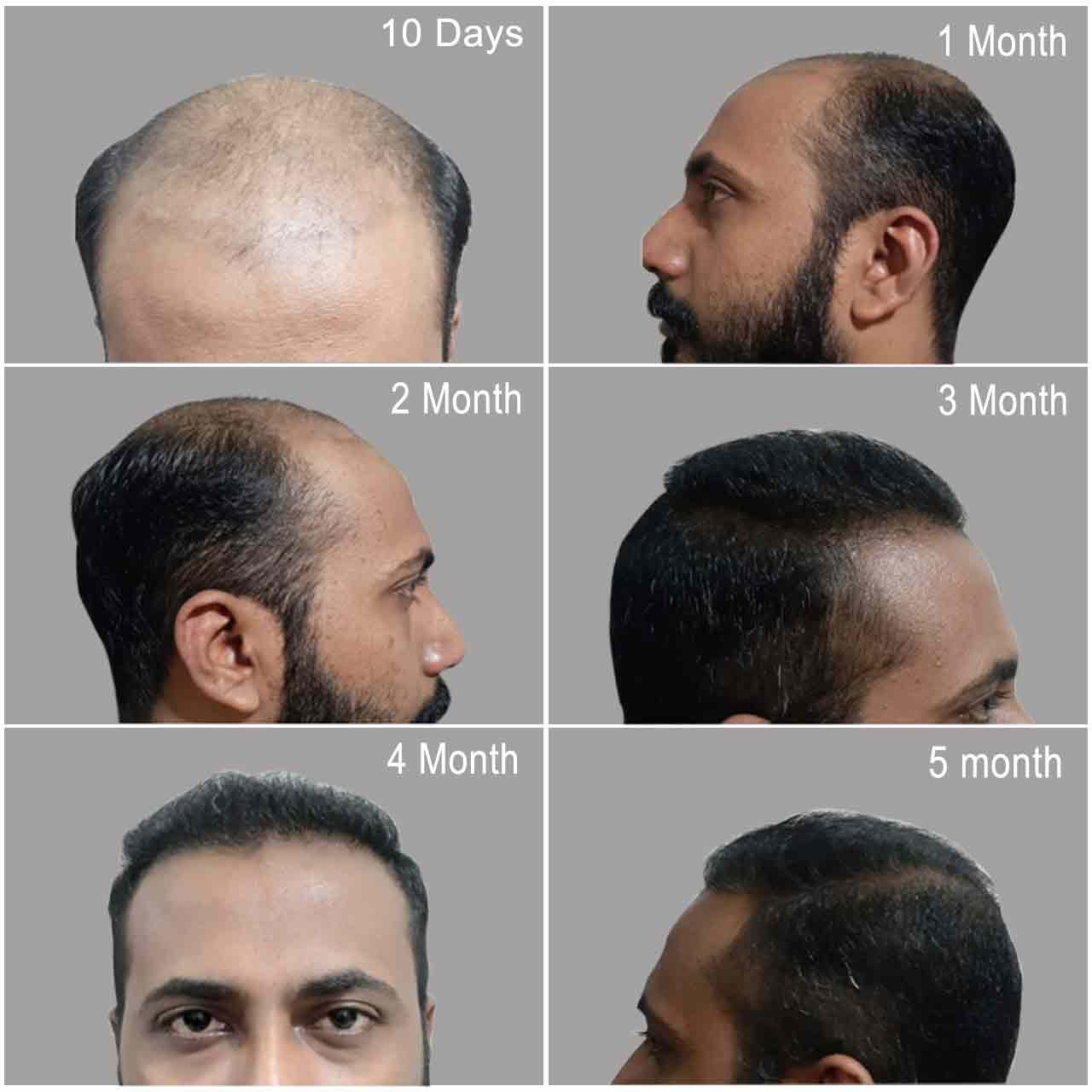 Hair Transplant Clinic in Kerala | Hair Loss Treatment in Kottayam& Calicut